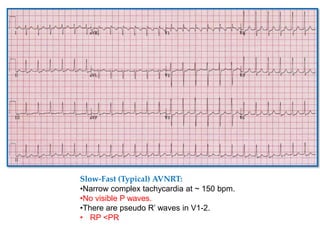 Slow-Fast (Typical) AVNRT:
•Narrow complex tachycardia at ~ 150 bpm.
•No visible P waves.
•There are pseudo R’ waves in V1-2.
• RP <PR
 