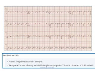 NARROW QRS TACHYCARDIA
 