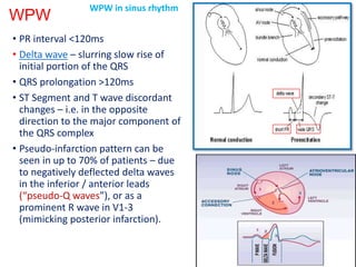 WPW
• PR interval <120ms
• Delta wave – slurring slow rise of
initial portion of the QRS
• QRS prolongation >120ms
• ST Segment and T wave discordant
changes – i.e. in the opposite
direction to the major component of
the QRS complex
• Pseudo-infarction pattern can be
seen in up to 70% of patients – due
to negatively deflected delta waves
in the inferior / anterior leads
(“pseudo-Q waves”), or as a
prominent R wave in V1-3
(mimicking posterior infarction).
WPW in sinus rhythm
 