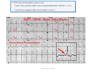 NARROW QRS TACHYCARDIA
 