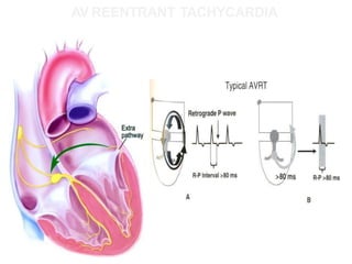 AV REENTRANT TACHYCARDIA
 