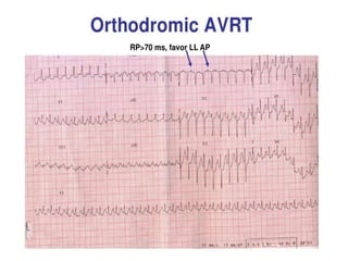 NARROW QRS TACHYCARDIA
 