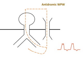 Antidromic WPW
 