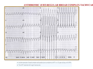 ANTIDROMIC AVRT-REGULAR BROAD COMPLEX TACHYCAR
 