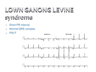  Short PR interval
 Normal QRS complex
 PSVT
 