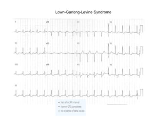 Lown-Ganong-Levine Syndrome
 