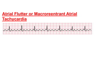 Atrial Flutter or Macroreentrant Atrial
Tachycardia
 