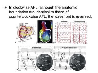  In clockwise AFL, although the anatomic
boundaries are identical to those of
counterclockwise AFL, the wavefront is reversed.
 