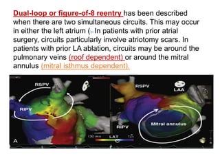 Dual-loop or figure-of-8 reentry has been described
when there are two simultaneous circuits. This may occur
in either the left atrium (31 In patients with prior atrial
surgery, circuits particularly involve atriotomy scars. In
patients with prior LA ablation, circuits may be around the
pulmonary veins (roof dependent) or around the mitral
annulus (mitral isthmus dependent).
 