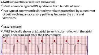 Comprehensive Guide to Narrow Complex Tachycardia: Diagnosis and ...