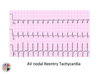 Narrow complex tachycardias | PPT