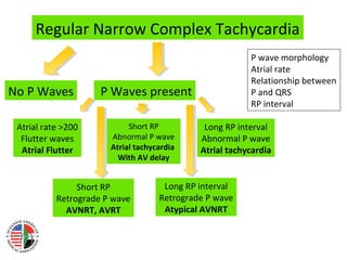 Narrow complex tachycardias | PPT