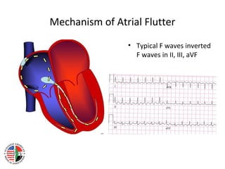 Narrow complex tachycardias | PPT