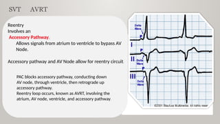 Approach to diagnosis of narrow complex tachycardia | PPTX