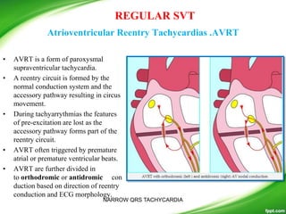 Narrow qrs tachy i.tammi raju | PPTX