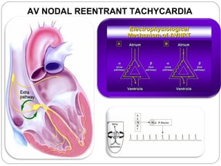 AV NODAL REENTRANT TACHYCARDIA
 