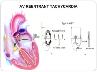 AV REENTRANT TACHYCARDIA
 