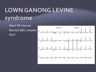  Short PR interval
 Normal QRS complex
 PSVT
 
