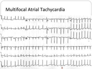 Multifocal Atrial Tachycardia
 