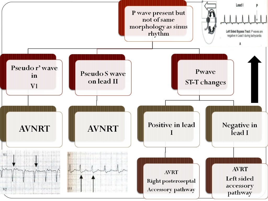 Narrow QRS Tachycardia