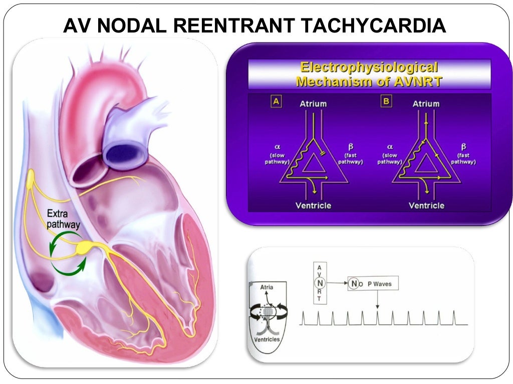Narrow QRS Tachycardia