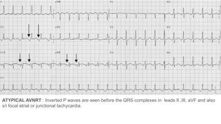 Comprehensive Overview of Narrow QRS Tachycardia and Supraventricular ...