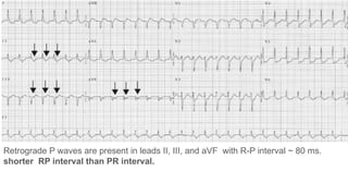 Comprehensive Overview of Narrow QRS Tachycardia and Supraventricular ...
