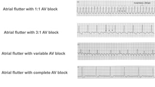 Comprehensive Overview of Narrow QRS Tachycardia and Supraventricular ...