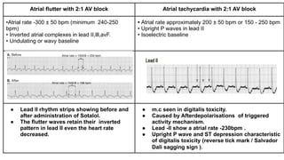 Inverted A Flutter Comprehensive Overview of Narrow QRS Tachycardia and Supraventricular ...