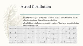 Narrow qrs tachycardia part 1 | PPTX