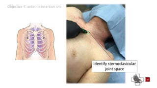 Power point of needle chest compressions | PPTX