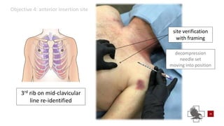 Power point of needle chest compressions | PPTX