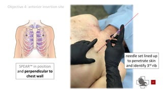 Power point of needle chest compressions | PPTX