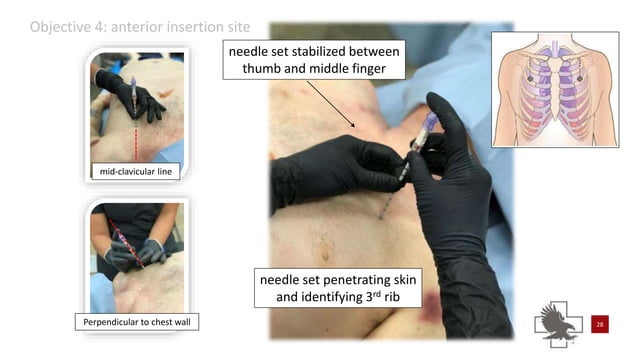 Power point of needle chest compressions | PPTX