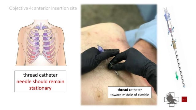 Power point of needle chest compressions | PPTX