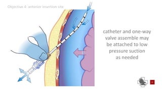 Power point of needle chest compressions | PPTX