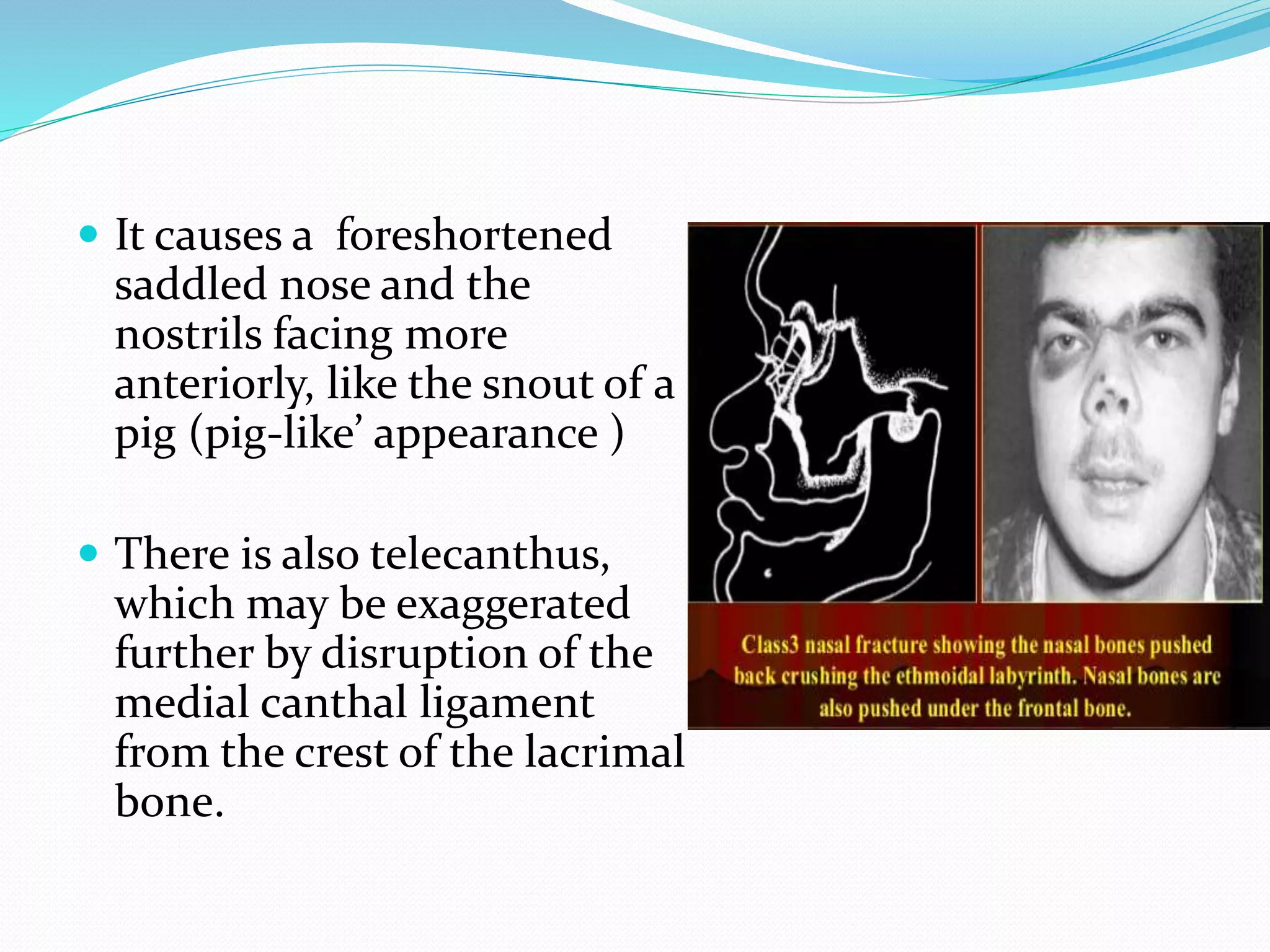 Nasal and facial fractures | PPTX
