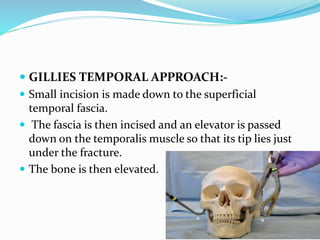 Nasal and facial fractures | PPTX