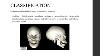 Fort Classification NASAL FRACTURES AND FACIAL FRACTURES.pptx
