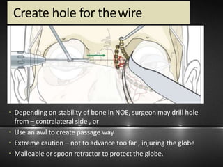 Nasal and noe fractures | PPTX