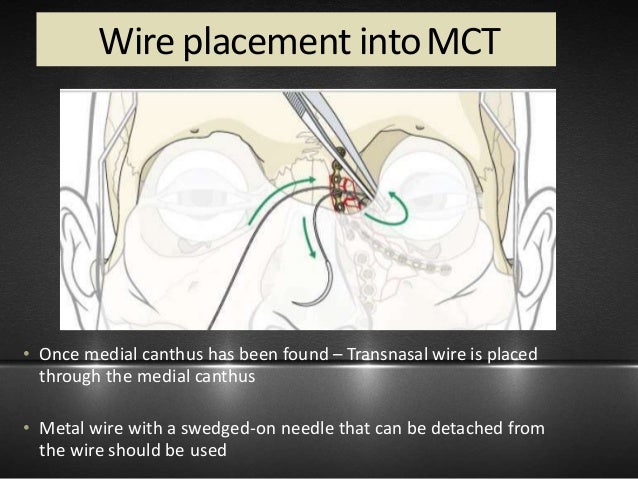 Nasal and noe fractures