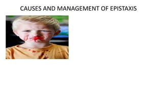 CAUSES AND MANAGEMENT OF EPISTAXIS
 