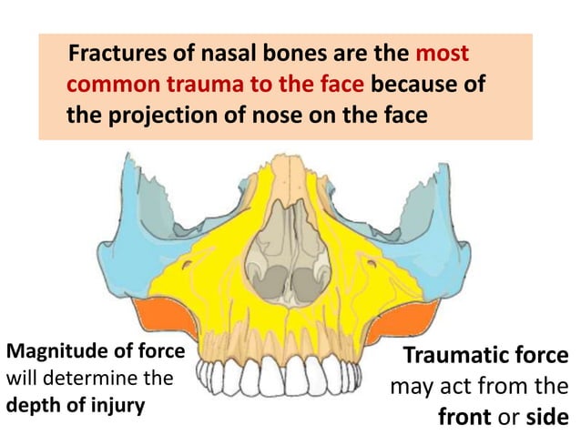 NASAL BONE FRACTURE | PPTX
