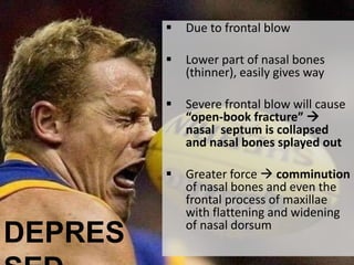  Due to frontal blow
 Lower part of nasal bones
(thinner), easily gives way
 Severe frontal blow will cause
“open-book fracture” 
nasal septum is collapsed
and nasal bones splayed out
 Greater force  comminution
of nasal bones and even the
frontal process of maxillae
with flattening and widening
of nasal dorsum
DEPRES
 