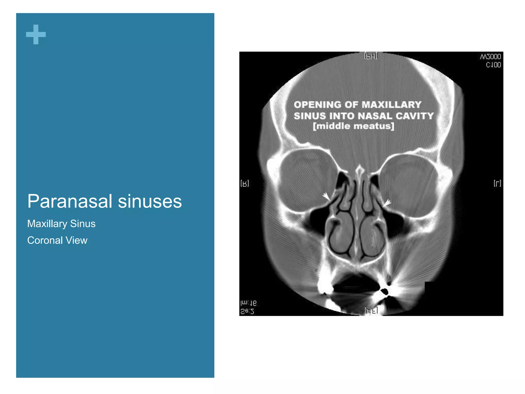 +



Paranasal sinuses
Maxillary Sinus
Coronal View        Turbinates
 