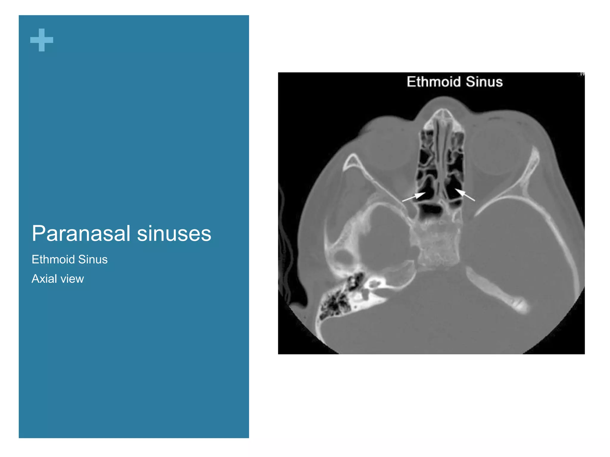 +



Paranasal sinuses
Ethmoid Sinus
Axial view          Turbinates
 