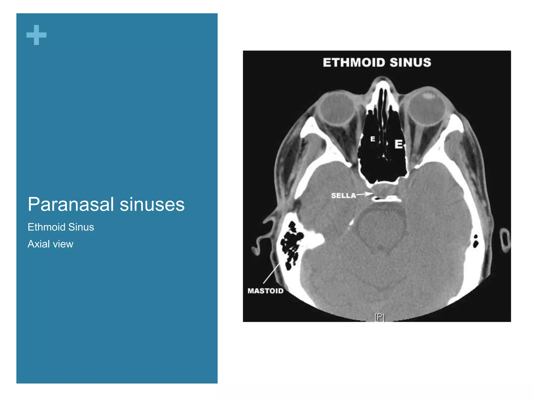 +



Paranasal sinuses
Ethmoid Sinus
Axial view          Turbinates
 