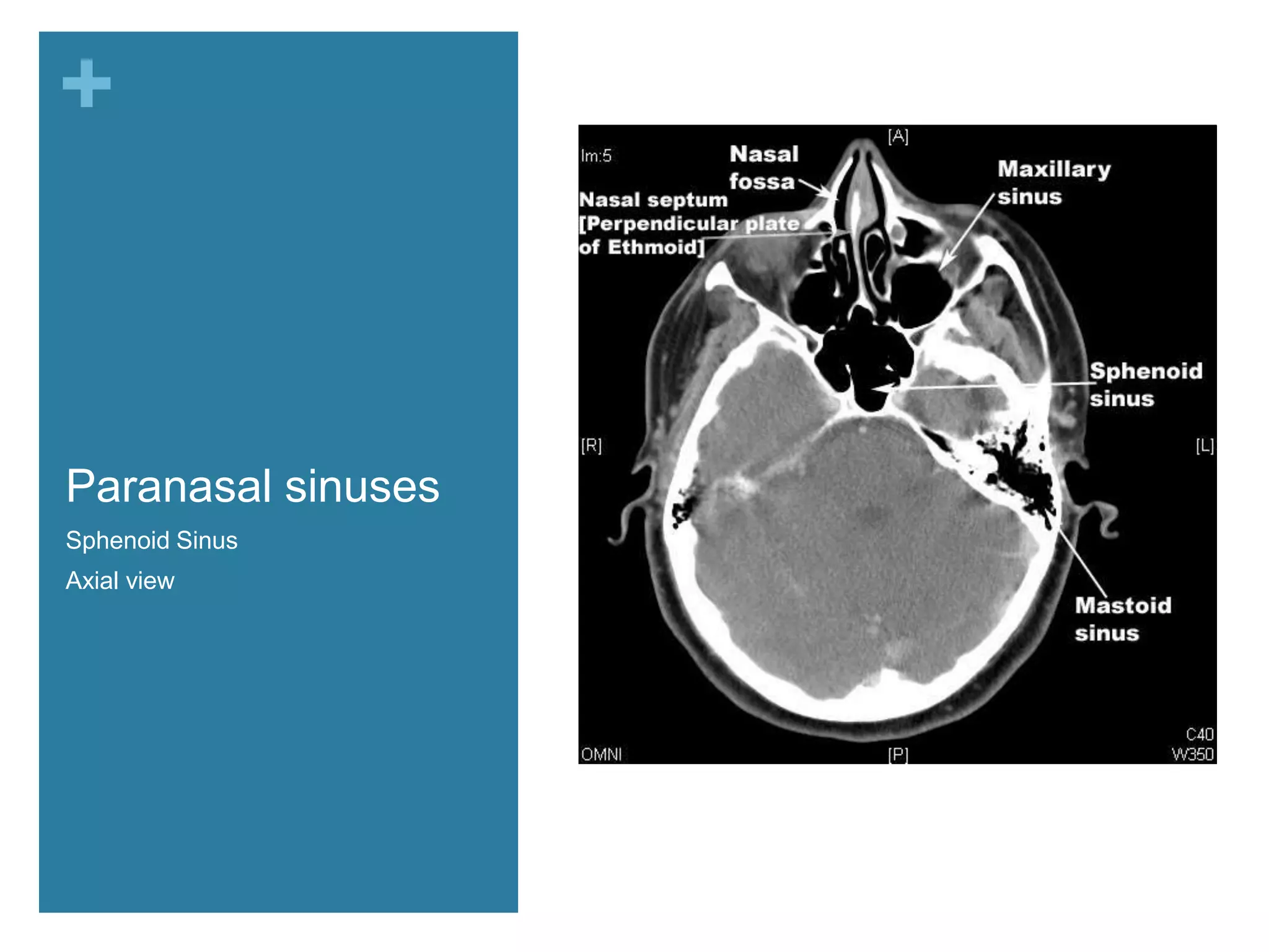 +



Paranasal sinuses
Sphenoid Sinus
Axial view          Turbinates
 