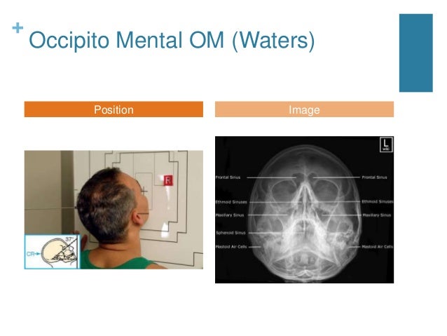 Nasal cavity and paranasal sinuses radiologic anatomy