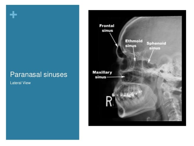 Nasal Cavity And Paranasal Sinuses Radiologic Anatomy